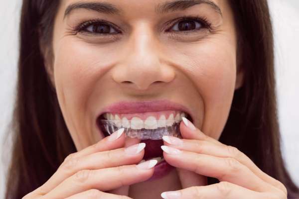 Invisalign: A Ortodontia Invisível